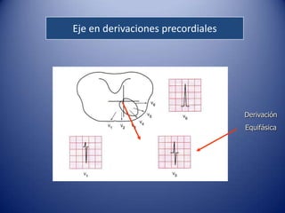 Eje en derivaciones precordiales




                                   Derivación
                                   Equifásica
 