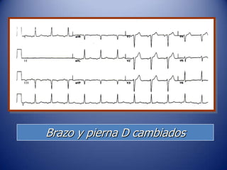 Brazo y pierna D cambiados
 