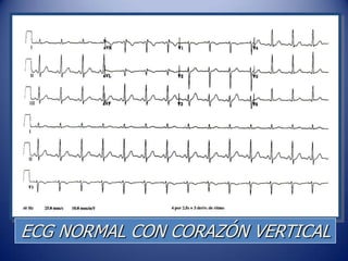 ECG NORMAL CON CORAZÓN VERTICAL
 