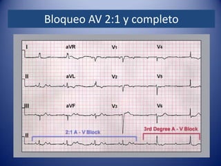Bloqueo AV 2:1 y completo
 