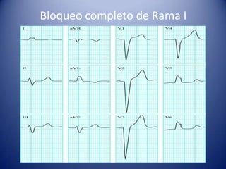 Bloqueo completo de Rama I
 
