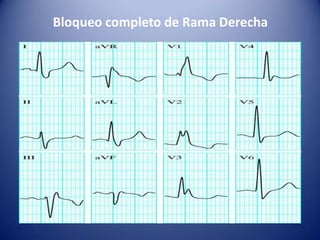 Bloqueo completo de Rama Derecha
 
