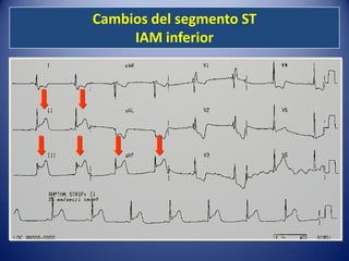 Cambios del segmento ST
     IAM inferior
 