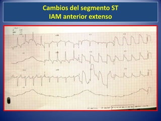 Cambios del segmento ST
  IAM anterior extenso
 