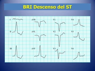 BRI Descenso del ST
 