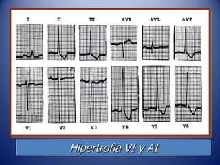 Hipertrofia VI y AI
 