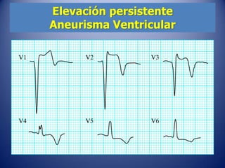 Elevación persistente
Aneurisma Ventricular
 