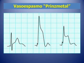 Vasoespasmo “Prinzmetal”
 