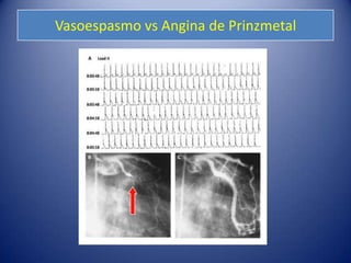 Vasoespasmo vs Angina de Prinzmetal
 