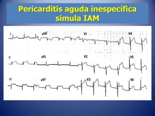 Pericarditis aguda inespecífica
          simula IAM
 