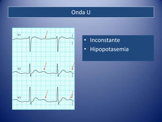 Onda U



   • Inconstante
   • Hipopotasemia
 