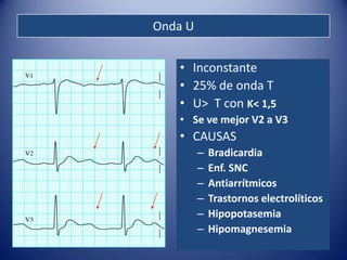 Onda U


   • Inconstante
   • 25% de onda T
   • U> T con K< 1,5
   • Se ve mejor V2 a V3
   • CAUSAS
         –   Bradicardia
         –   Enf. SNC
         –   Antiarrítmicos
         –   Trastornos electrolíticos
         –   Hipopotasemia
         –   Hipomagnesemia
 