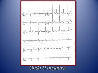Onda U negativa
 
