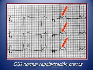 ECG normal repolarización precoz
 