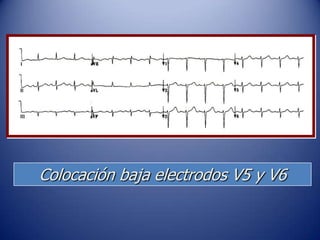 Colocación baja electrodos V5 y V6
 