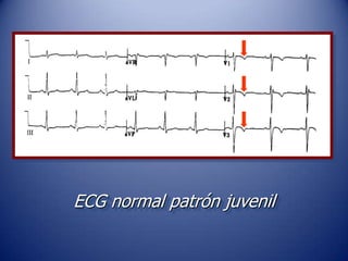 ECG normal patrón juvenil
 