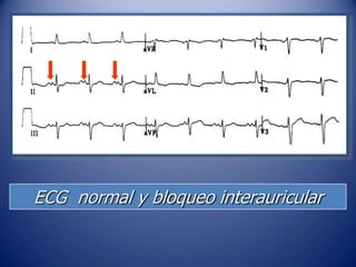 ECG normal y bloqueo interauricular
 
