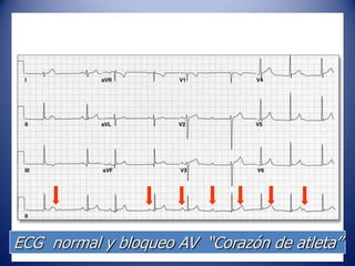 ECG normal y bloqueo AV “Corazón de atleta”
 