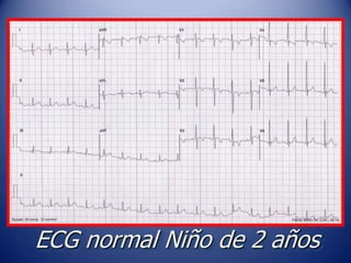 ECG normal Niño de 2 años
 