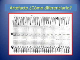 Artefacto ¿Cómo diferenciarlo?
 