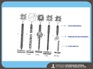 COTO PROXIMAL

FORMAÇÃO DO NEUROMA

COTO DISTAL

Prof. Ronny M de Moraes 141

141

 