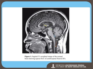 Figure 1. Sagittal T1-weighted image of the normal
brain showing typical flow of cerebrospinal fluid (CSF).

Prof. Ronny M de Moraes 175

 