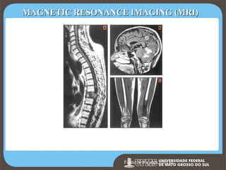 MAGNETIC RESONANCE IMAGING (MRI)

A. Magnetic resonance image (MRI) showing T8 metastasis from renal cell carcinoma.
B. MRI showing AIDS-related lymphoma of the central nervous system.
C. MRI showing osteosarcoma of the distal femoral metaphysis in an 11 year old boy.

Prof. Ronny MFonte:Moraes 259
de www.mja.com.au

259

 