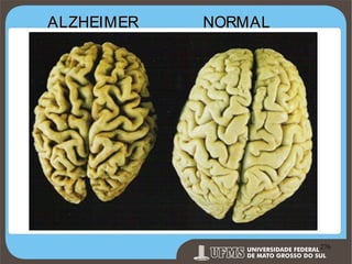 ALZHEIMER

NORMAL

Prof. Ronny M de Moraes 276

276

 