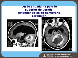 Lesão situada na porção
superior do vermis,
estendendo-se ao hemisfério
cerebelar.

Prof. Ronny M de Moraes 284

284

 