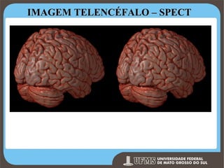 IMAGEM TELENCÉFALO – SPECT

Prof. Ronny M de Moraes 50

 