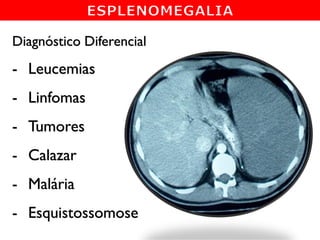 Diagnóstico Diferencial
- Leucemias
- Linfomas
- Tumores
- Calazar
- Malária
- Esquistossomose
 