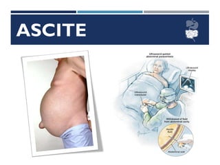 ASCITE
 