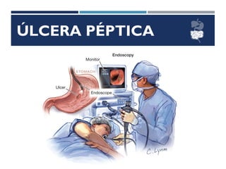 ÚLCERA PÉPTICA
 