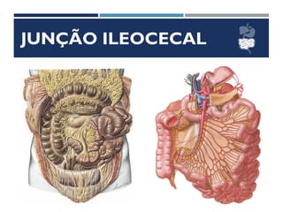 JUNÇÃO ILEOCECAL
 