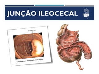 JUNÇÃO ILEOCECAL
 