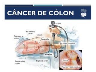 CÂNCER DE CÓLON
 