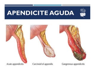 APENDICITE AGUDA
 