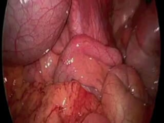 INTESTINO GROSSO
 