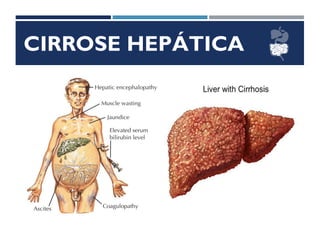 CIRROSE HEPÁTICA
 
