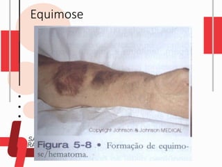 Equimose
 