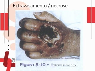 Extravasamento / necrose
 