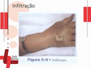 Infiltração
 