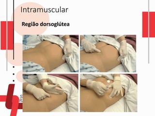 Intramuscular
Região dorsoglútea
 