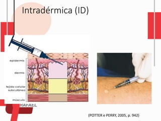 Intradérmica (ID)
(POTTER e PERRY, 2005, p. 942)
 