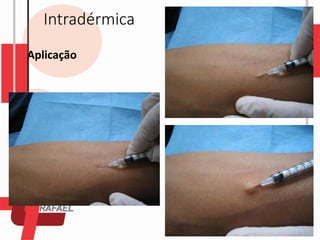 Intradérmica
Aplicação
 