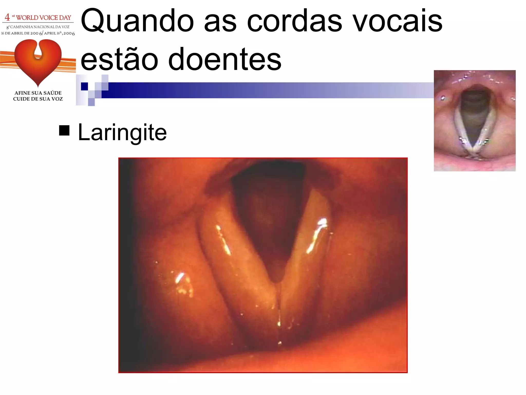 Laringite Quando as cordas vocais estão doentes 