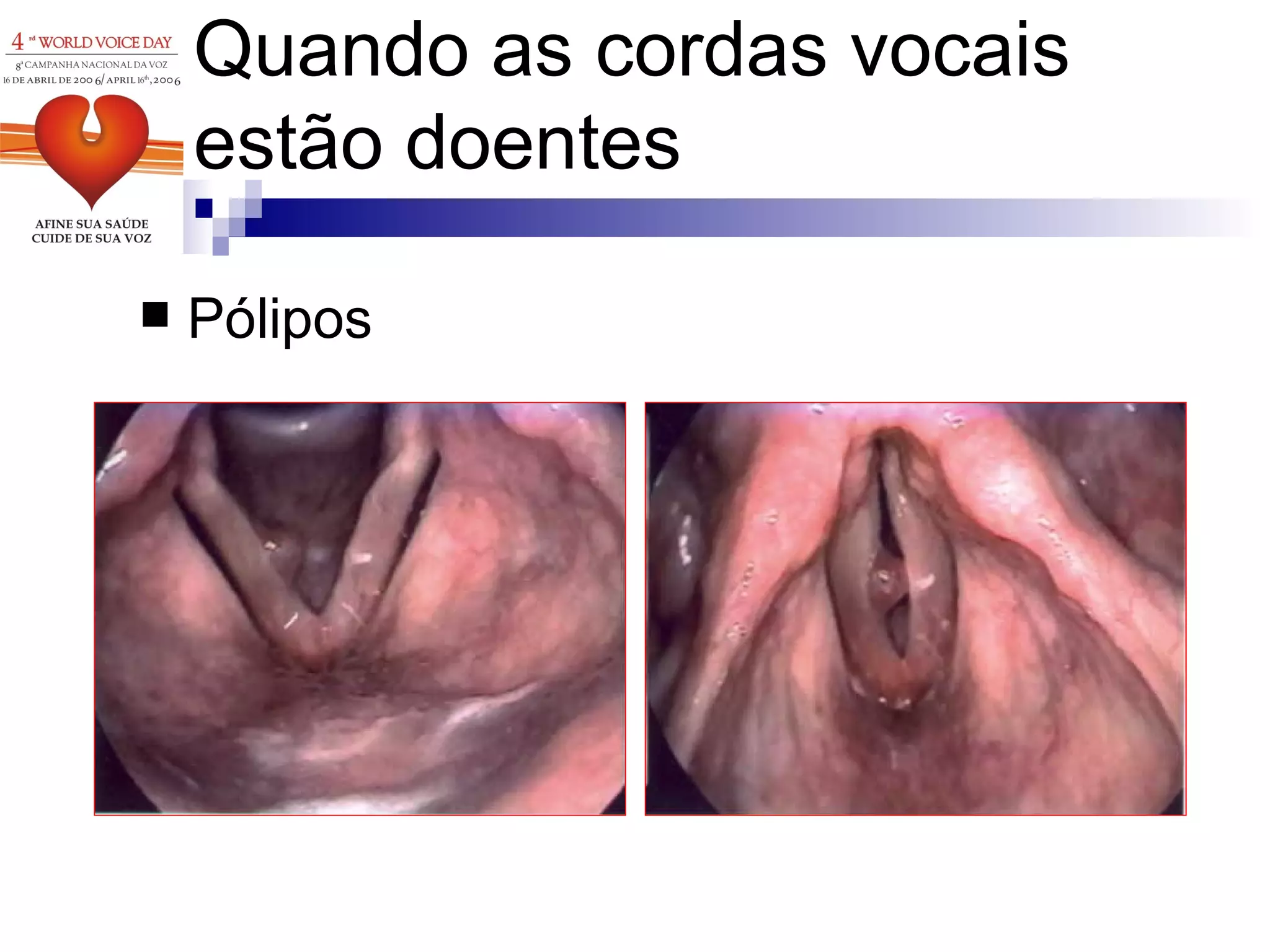 Pólipos Quando as cordas vocais estão doentes 