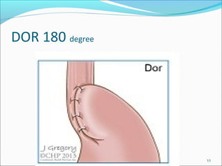 Fundoplication and heller's myotomy | PPT