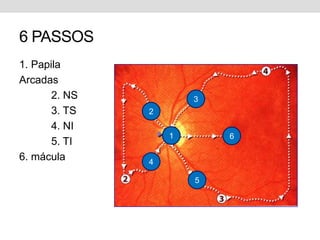 6 PASSOS
1. Papila
Arcadas
2. NS
3. TS
4. NI
5. TI
6. mácula
1
2
3
4
5
6
 