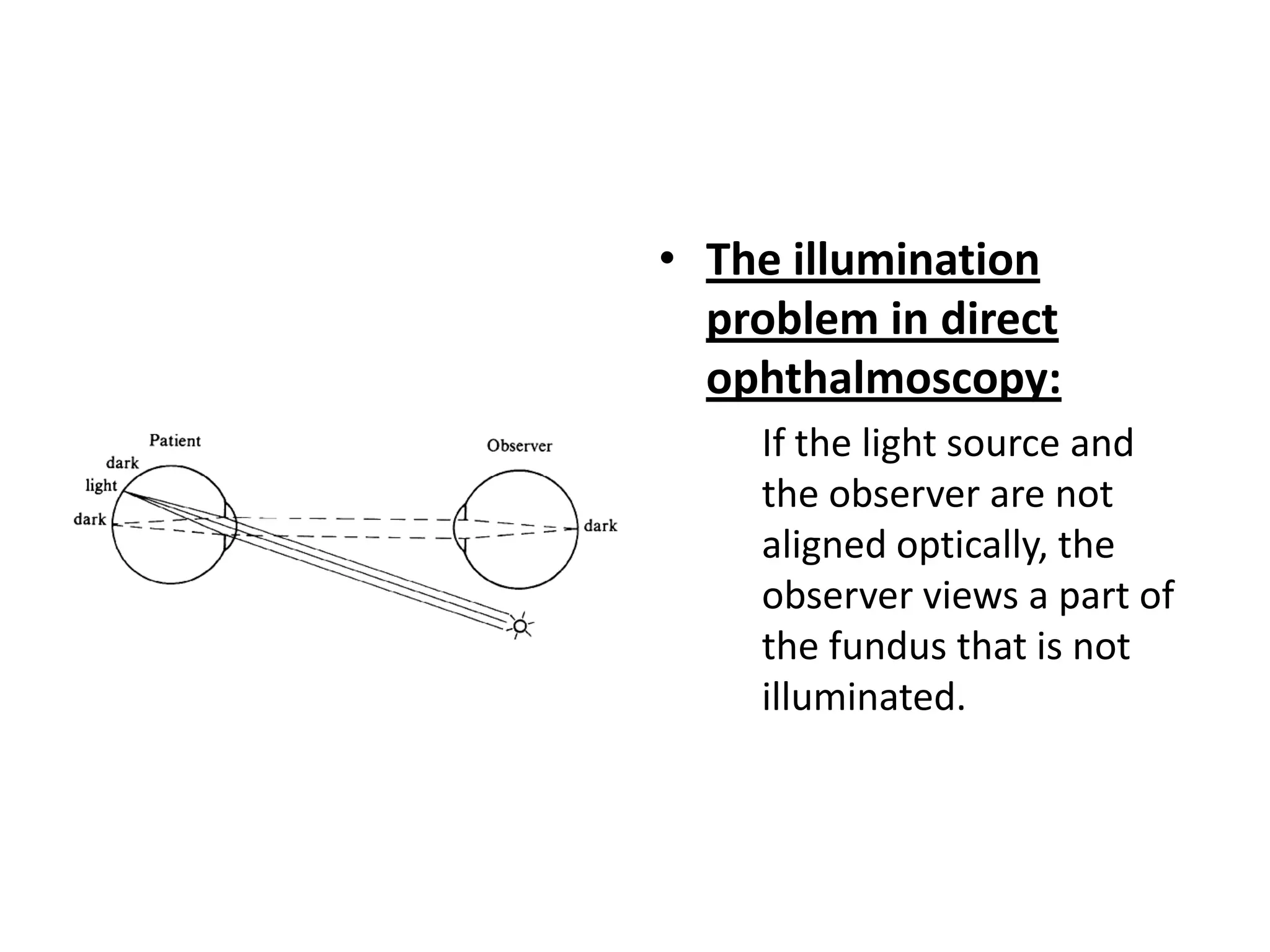 • The illumination
problem in direct
ophthalmoscopy:
If the light source and
the observer are not
aligned optically, the
observer views a part of
the fundus that is not
illuminated.

 